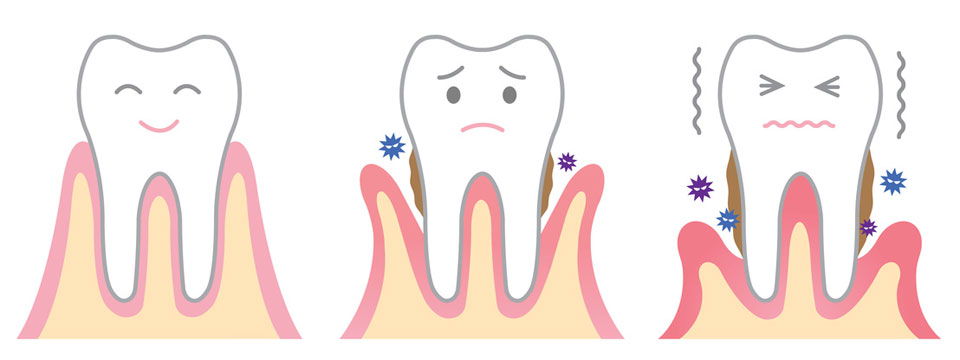 parodontitis-fogíny betegség